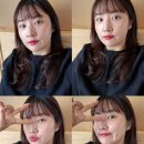 [강남/논현]콜라겐주사 팔자주름 미희주사 통증, 전후효과 강남피부과