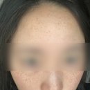 역삼동 기미 주근깨 한번에 박멸 후기, 미작뷰티 강남본점