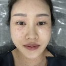 정든약국 | 임신 후 생긴 기미 잡티 편평사마귀 제거 후기