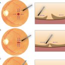용성동물병원 | 황반원공 수술 치료법: 안과 전문의 시력회복 가이드