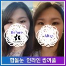 수눈 | 인라인쌍꺼풀, 함몰눈도 자연스러울 수 있을까요? 실제 후기로 알아봅니다