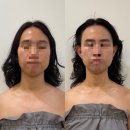 젠한방 | [젠에스테틱]얼굴축소와 라인정리를 한방에 구미시 에스테틱 전문점 인의동 피부관리 젠에스테틱 솔직후기