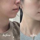 디오레의원 쿨소닉 6000샷 후기 통증 없이 해결한 이중턱 팔자주름 고민 해결