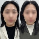 청담준의원 | [서울/청담] 이중턱 고민 없애준 온리딥(온다 + 쓰리딥) 리프팅 리얼후기_루셀의원