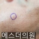 수원에버성형외과의원 네이버블로그