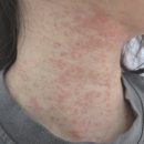 수피부과의원 | 🌞햇빛 알레르기로 미칠 듯한 가려움… 평택 송탄 피부과 봄피부과의원 다녀온 후기(광고아님)