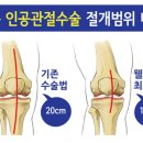 [인공관절수술잘하는곳] 무릎퇴행성관절염, 무릎인공관절수술로 해결!! 이미지