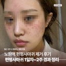 노원역 5번출구 | 노원역 편평사마귀 제거 후기｜편평사마귀 1일차~2주 경과 정리