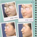 엘란쎄필러 잘하는곳 메이저피부과 후기입니당~