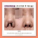 구축코 재수술 자가늑으로 자연스럽고 안전하게