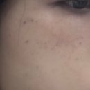 메디힐의원 | [엑셀브이/내돈내산]엑셀브이 색소 제네시스 후기~ing(1회차) 통증ㅣ후 관리ㅣ사용제품