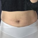 식욕억제 도움받은 다이어트한약 오꽃다온 + 온비채 후기 (몸매 비포&amp;애프터 포함)