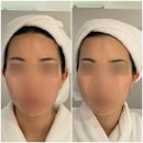 목동2차아크로텔 뒤 | 목동피부관리 엘피지오 목동점 써마웨이브 프리미엄 리프 솔직 후기