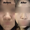 가나부분정비 | 압구정 피부과 포텐자 + 엑소좀 줄기세포 스킨부스터 1회 효과 및 후기