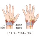 손목 수근관 증후군 이미지