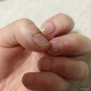 혜화가정의원 | [30대 유방암 1기·허투양성] 80. TCH 항암 1차 2주차: 한포진으로 피부과 내원 /처음 느낀 공황 증상