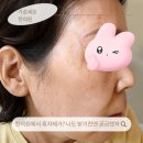 친정엄마 - 북구 | 범계 흑자제거 내돈내산, 기미인 줄 알았던 친정엄마 상담 후기