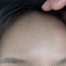 남악고운의원 | 남악고운의원 탄력개선 슈링크리프팅(+비립종 제거 후기)