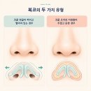 레이디 - 마포구 | 복코교정, 코필러 하면 안됩니다. 수술없이 복코쿄정 가능한 레이디코 후기