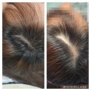 삭발청년아카데미 | 두피 흉터커버로 다녀온 전북두피문신잘하는곳 삭발청년아카데미 시술후기