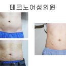 얼굴 리프팅을 울트라 v 라인으로 안전하며 확실한 효과가 있는걸 아심니까?? 팔자주름 목주름 등 각종주름..뱃살 종아리 축소도 탁월한 효과가 있음니다.. 이미지