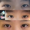 다금차 | 눈매교정 이물감 쌍수 절개 앞트임 붓기 실밥제거 1~2주 차 후기
