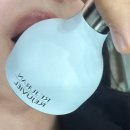 LOL House | 입술 점 뺀 후기 - 가격, 통증, 점빼기 종류, 시간, 재발 등 안내