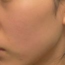 스펀지성형외과의원 | 속부터 꽉 찬 리투오 3주 경과 전후차이 본격 비교