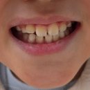 서울플라워치과교정과치과의원 | 서울클리어치과교정과치과의원 평택고덕 악궁확장 진행 중.