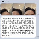 수헤어라인 이미지