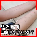 가로수동물병원 | 산본서울이비인후과 알레르기 피부반응검사 초등아들잦은기침