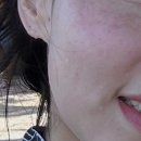 정선화장품 | 경산시지피부관리 정선 에스테틱 보홀 여행 후 붉어진 피부, 고주파 탄력관리 솔직 후기