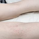 황새울로312번길 | [종아리, 허벅지, 다리 튼살제거 가격]시술 후 관리 후기! 주블링 스킨52 분당