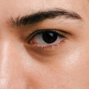 더스완성형외과의원 | 자연스러운 눈매를 위한 선택, 눈매교정 자연유착 방법