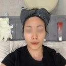 땅콩짐 | 땅콩형얼굴 고주파 강남역리프팅 볼뉴머 600샷 효과 후기