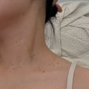 누가가정의학과 | 대구 신세계가정의학과 편평사마귀 제거 후기