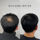 홍대 두피문신 후기, 정수리 헤어라인 두피문신 받았어요