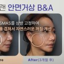 유의미외과의원 | 안면거상 흉터 부작용 줄이는 노하우 공개합니다 (실제 수술 Case 후기 사진 주의)