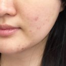 카프리 | 송도피부과 여드름관리 좁쌀 여드름 압출, 카프리레이저 후기