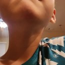 새가야약국 | 미국 생활 첫 응급상황 기록｜아이 턱 봉합부터 실밥 제거까지. 미국 얼전케어 후기