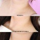 멍야미 | ㅊㅇㄹ 루미넥 2번째 찐후기! 목주름필러 유지력, 주기, 통증, 다운타임,부작용 전부 알려줄게