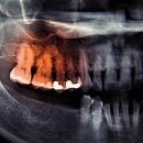 이빨 잃으면 각종 암‧치매 위험 ‘급증’…“구강세균이 장기에 직접 영향” 이미지