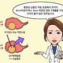 난소낭종 , 난소혹 원인 난소물혹 이미지