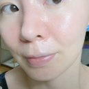 다산역 피부과 PRF 재생주사 줄기세포 피부주사 내돈내산 후기!