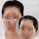 전주탈모관리 고민 끝내고 전주smp 받은 리얼 후기, 헤어라인 달라지니까 자신감도 달라졌어요