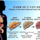 * 알콜중독 원인과 치료 * 이미지