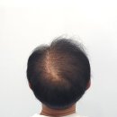 디비전 스칼프 | 수원두피문신 무료체험 받아보고 결정하세요