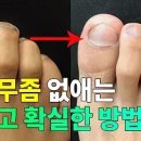 ﻿발톱무좀 치료방법 알고 싶다면 드루와 이미지