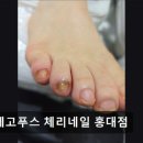 디에고푸스 체리네일 홍대점 | 홍대입구역 네일샵 디에고푸스 체리네일 문제성 손발톱도 건강하게