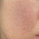 루미인피부과의원 | 리쥬란힐러 시술 후 주사 자국 부작용일까요? | 엠보싱 기간은?